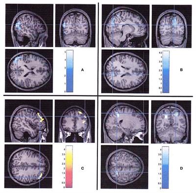 Severe Hypoglycemia: Is It Still a Threat for Children and Adolescents With Type 1 Diabetes?